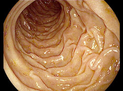 Absteigender Zwölffingerdarm