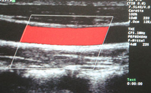 Ultraschallbild (Duplexsonographie):  normale Halsschlagader