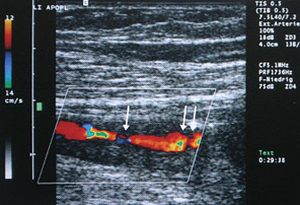 Ultraschallbild (Duplexsonographie):  verengte Schlagader