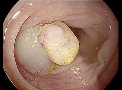 Unterspritzter Polyp