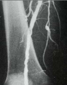 Oberschenkelarterie nach Wiedereröffnung (Dilatation)